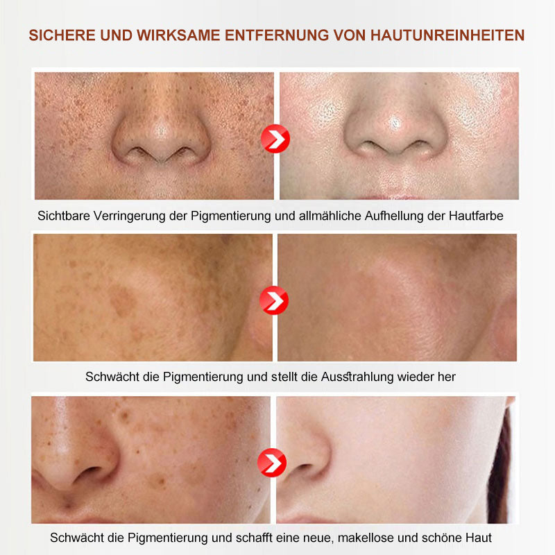 Pflanzenaufhellende Melanin-Sommersprossencreme