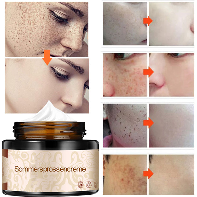 Pflanzenaufhellende Melanin-Sommersprossencreme